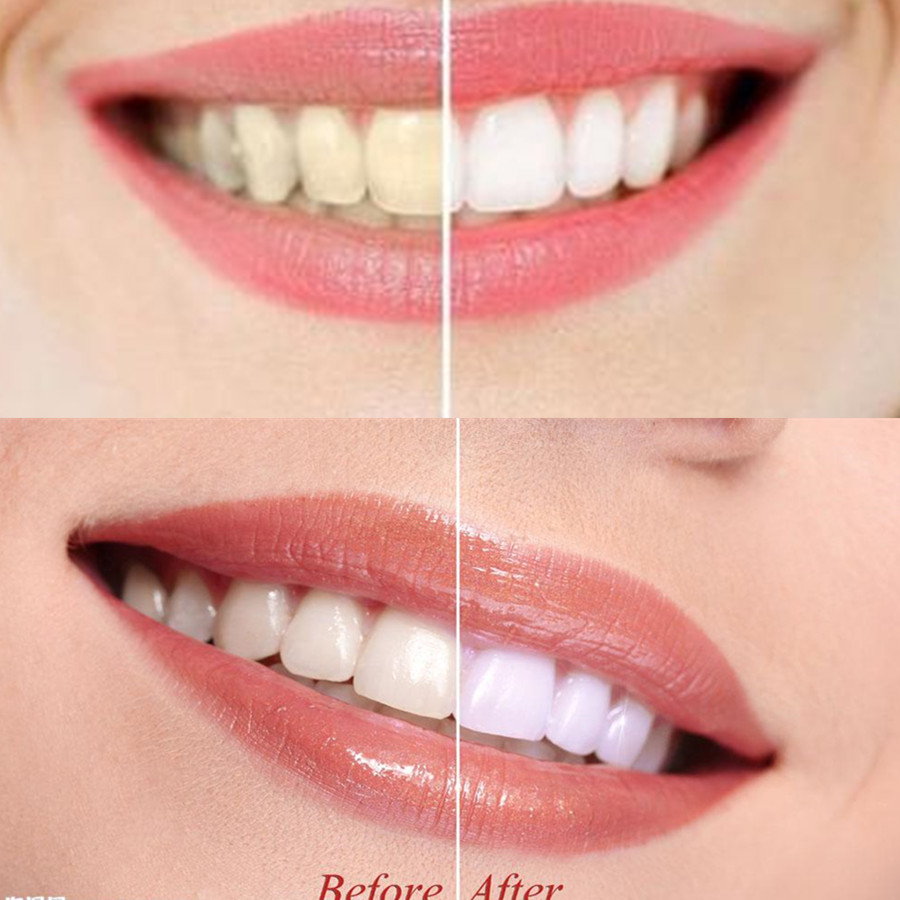 Than Tre Răng Răng Nha Khoa De - đánh giá và giá Teeth Whitening Zimba