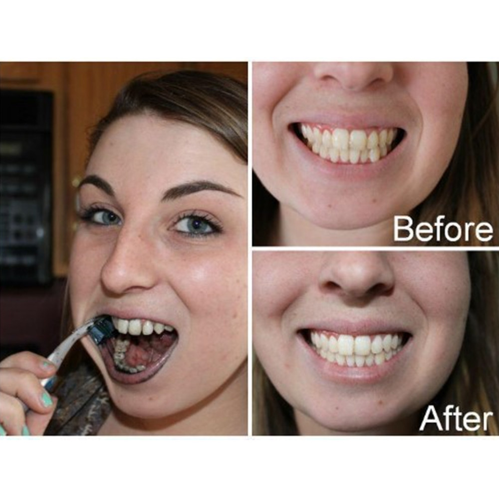 Than Tre Răng Răng Nha Khoa De - đánh giá và giá Teeth Whitening Zimba
