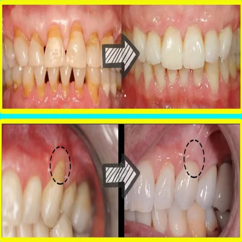 Quickly Repair Gum Serum Relie - đánh giá và giá Teeth Whitening Baking Soda