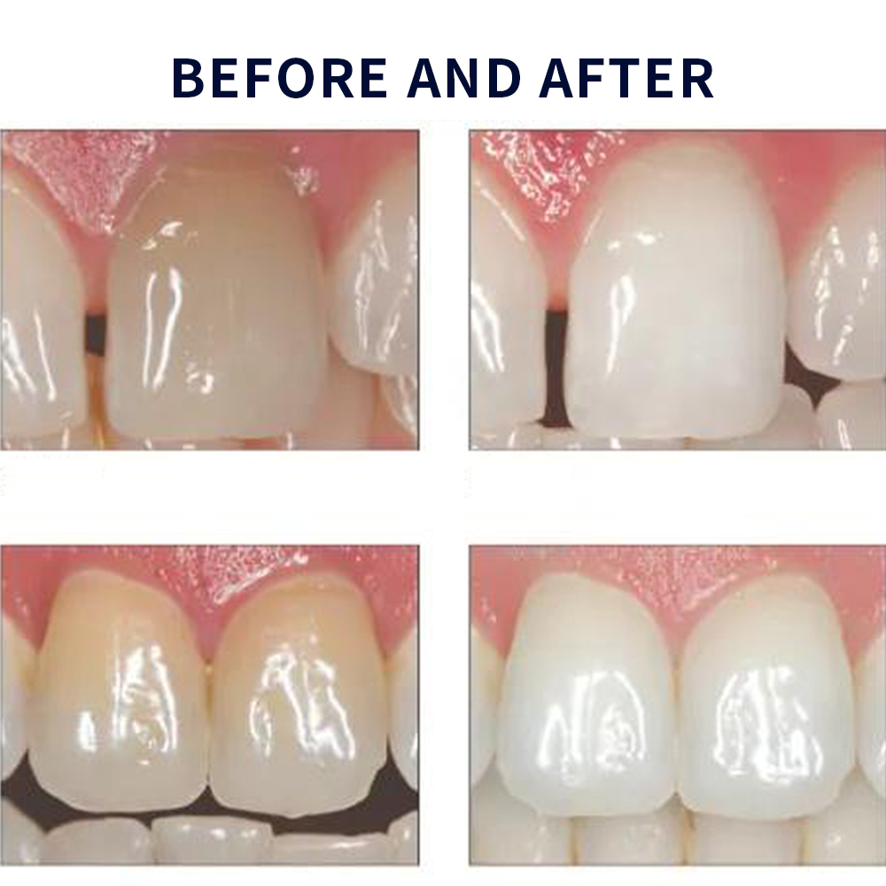 Opalescence Whitening 20% PF 2 - đánh giá và giá Teeth Whitening Gel Peroxide
