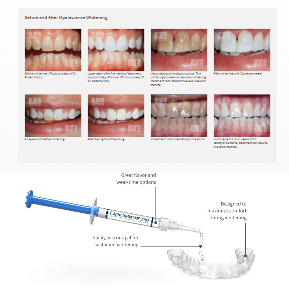 Opalescence Whitening 20% PF 2 - đánh giá và giá Teeth Whitening Gel Peroxide