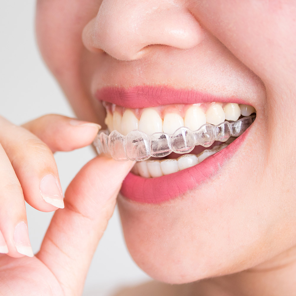 2/4pcs Professional Tooth Orth - đánh giá và giá Teeth Whitening With Trays