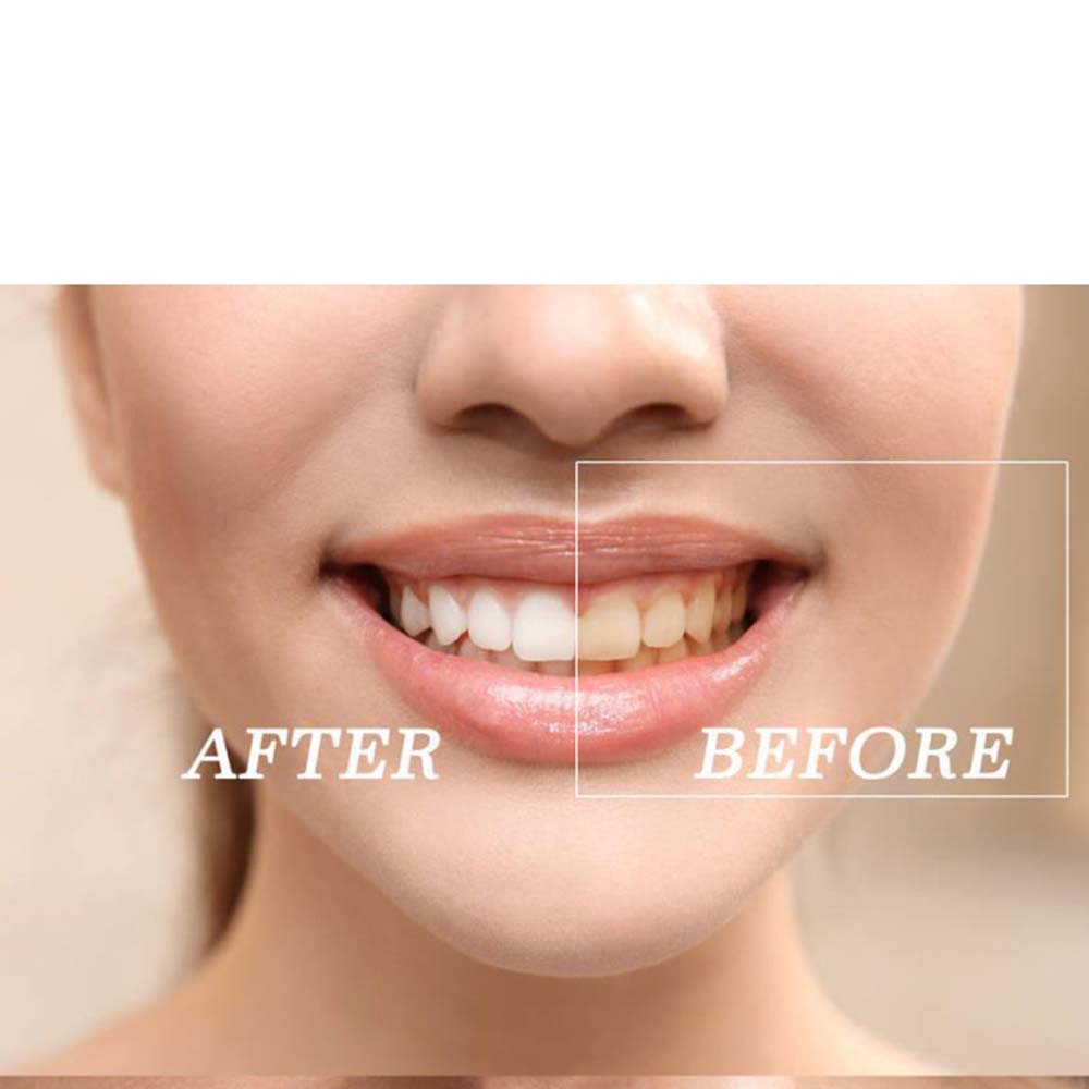 Chất Lượng Hàng Đầu Peroxide L - đánh giá và giá Teeth Whitening Gel Peroxide