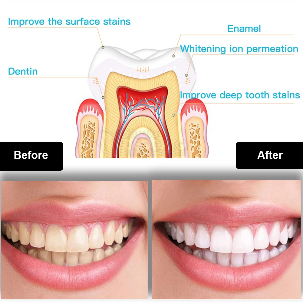 Dental Teeth Whitening Kit Min - đánh giá và giá Teeth Whitening Gel Peroxide